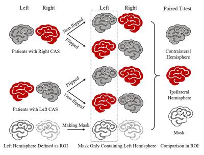 Measurement of Cortical Atrophy and Its Correlation to Memory Impairment in Patients With Asymptomatic Carotid Artery Stenosis Based on VBM-DARTEL